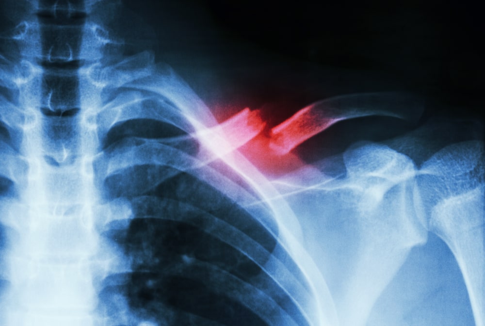Houston Bone Fracture Injury from a Car Accident